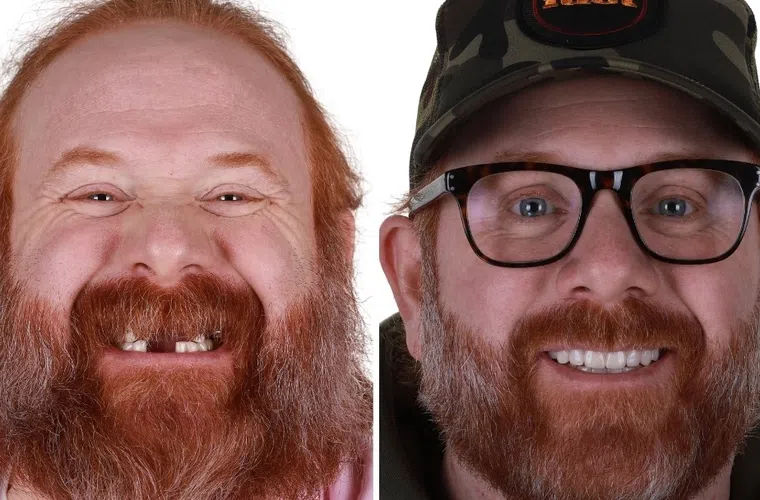 Before and after images of a red-bearded man showing dental transformation with improved teeth and smile.