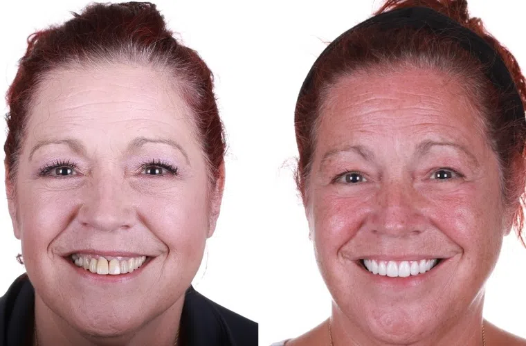 Before and after dental restoration showing improved teeth alignment and bright smile in middle-aged woman.