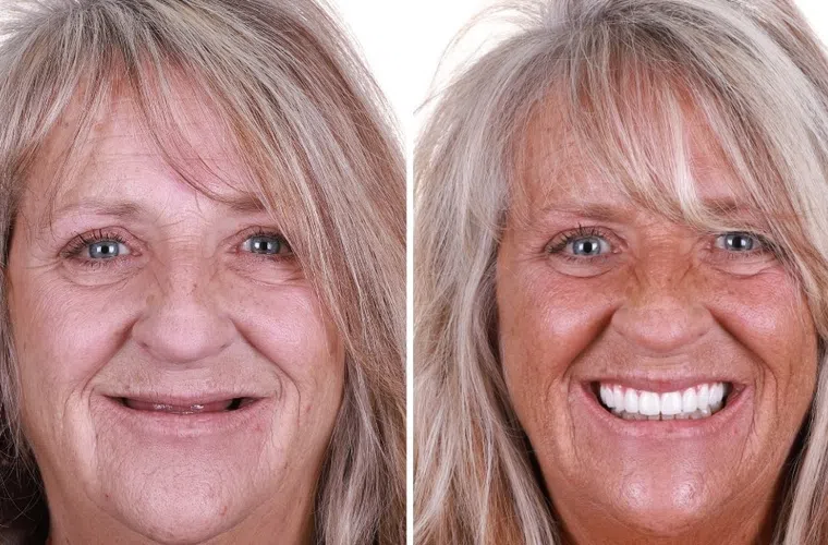 Before and after dental restoration showing a woman's smile transformation with new white teeth in close-up views.
