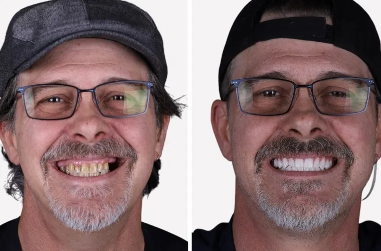 Before and after dental restoration showing man with improved teeth color and alignment, smiling with glasses and cap.
