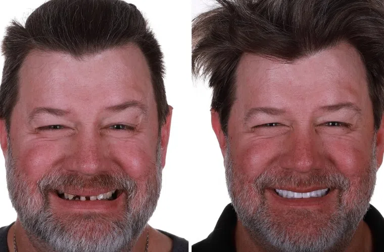 Before and after dental restoration showing a man with missing and damaged teeth transformed to healthy white teeth.