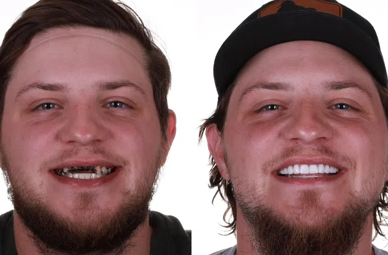 Before and after images show a man's dental transformation with severely decayed teeth replaced by bright white veneers.