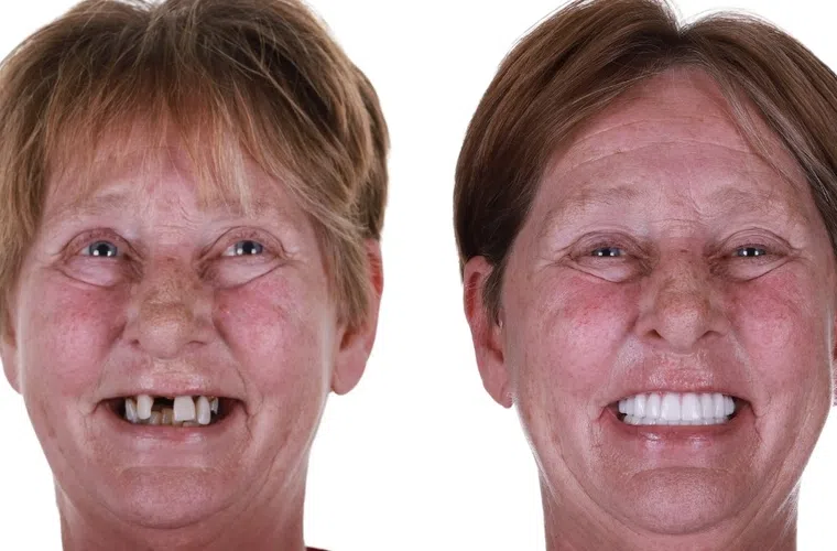 Before and after dental restoration showing a woman with damaged teeth transformed to a bright, healthy smile.