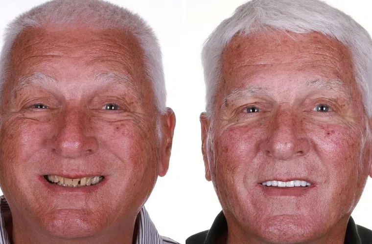 Before and after dental restoration on an elderly man showing improved teeth appearance and smile.