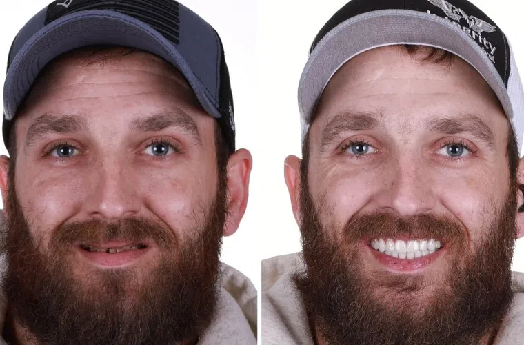 Before and after dental restoration showing a man with missing teeth then a full set of bright white teeth and a happy smile.