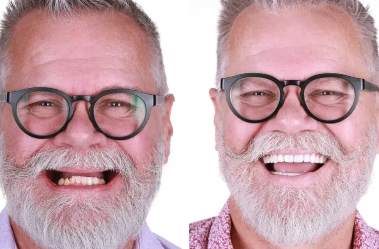 Before and after dental restoration showing an older man with missing teeth transformed to a full, bright smile.