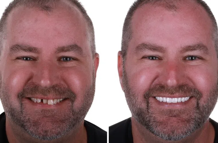 Before and after photos of a man showing dental transformation with improved teeth and smile.