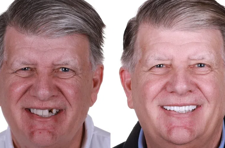 Before and after dental restoration on an older man showing a full set of clean, white teeth and improved smile.