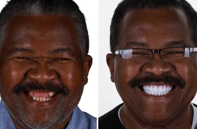 Before and after photos showing dental transformation with missing teeth replaced by bright white dentures.