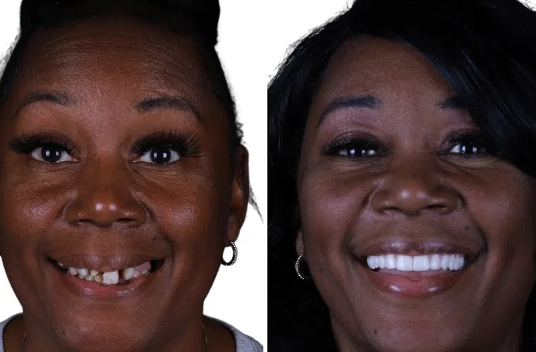 Before and after dental restoration showing a woman with damaged teeth and her new bright smile.
