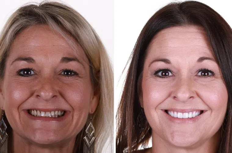 Before and after dental makeover showing improved teeth alignment and whitening with smiling women.