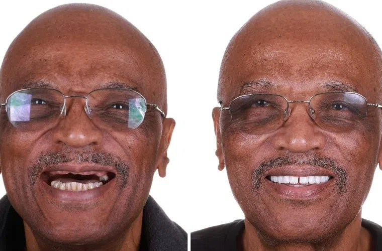 Before and after dental restoration showing an elderly man with missing teeth and a bright new smile.