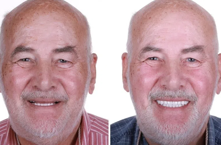 Before and after dental restoration showing an elderly man smiling with improved, whiter teeth in close-up and facial views