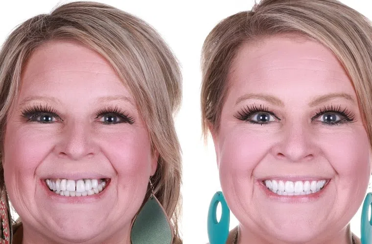 Before and after dental restoration showing improved smile and clean, bright teeth with close-up views.