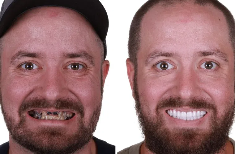 Before and after dental restoration showing a man's decayed teeth transformed to a bright white smile.
