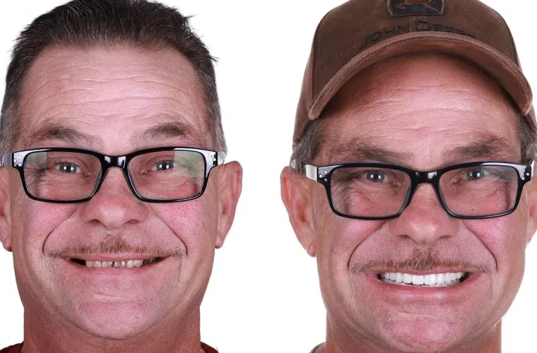 Before and after dental restoration showing a man’s improved smile with new white teeth and close-up details.