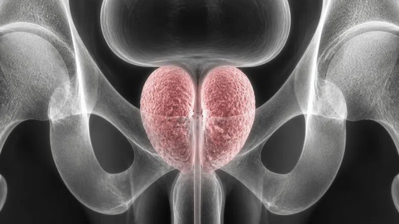 X-ray view of male pelvic bones highlighting the prostate gland in pink between the bladder and urethra.