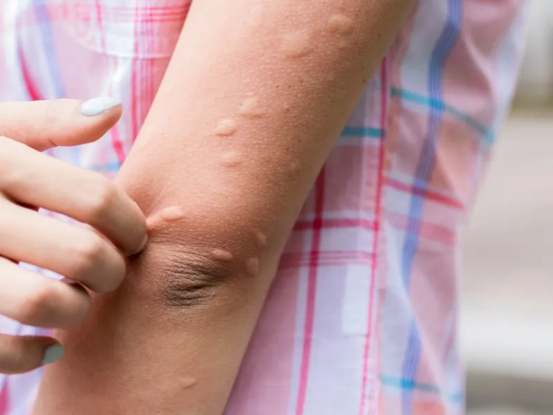 Nine Reasons Why Mosquitoes Love You