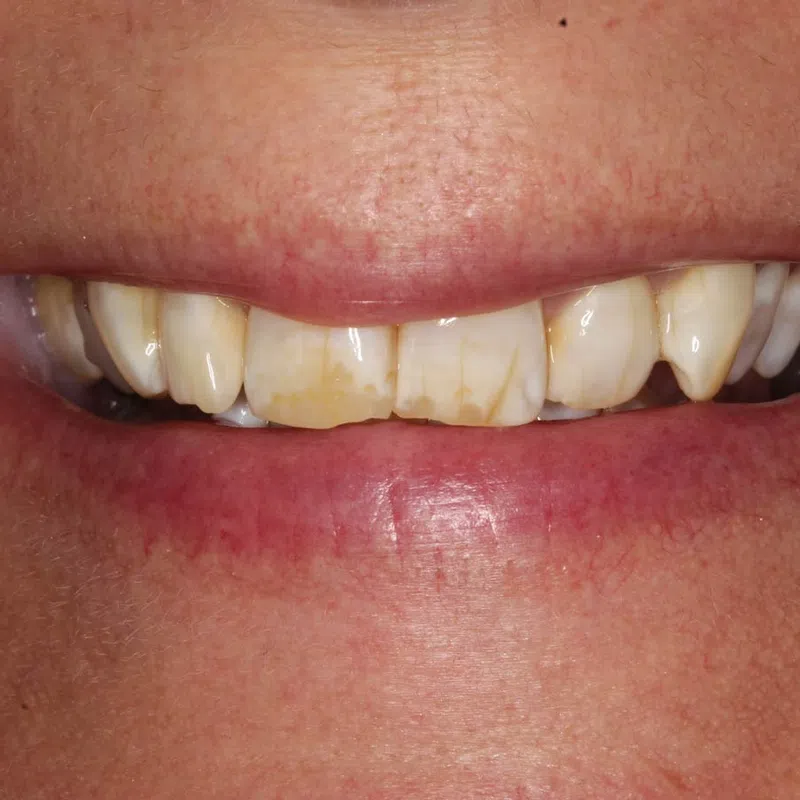 Close-up of a smile showing stained, discolored front teeth and lips with visible skin texture.