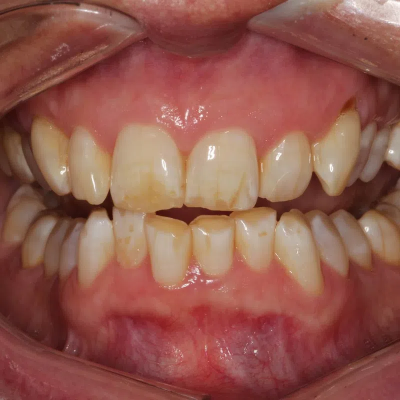 Close-up of stained and misaligned teeth with dental cheek retractor in mouth.