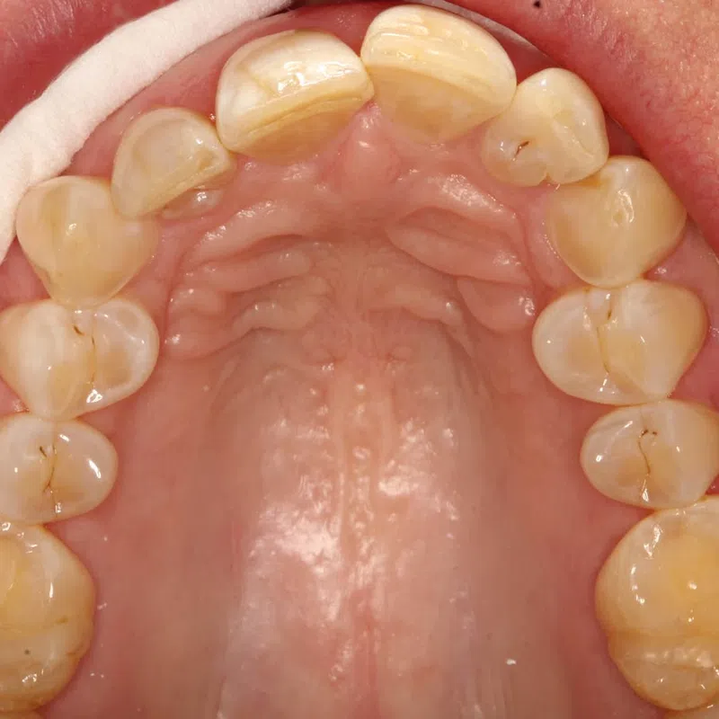 Close-up view of upper teeth and palate showing dental enamel with minor stains and natural oral anatomy.