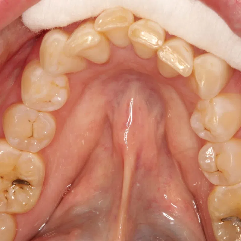 Close-up of upper teeth showing dental cavities and plaque buildup on molars and premolars.