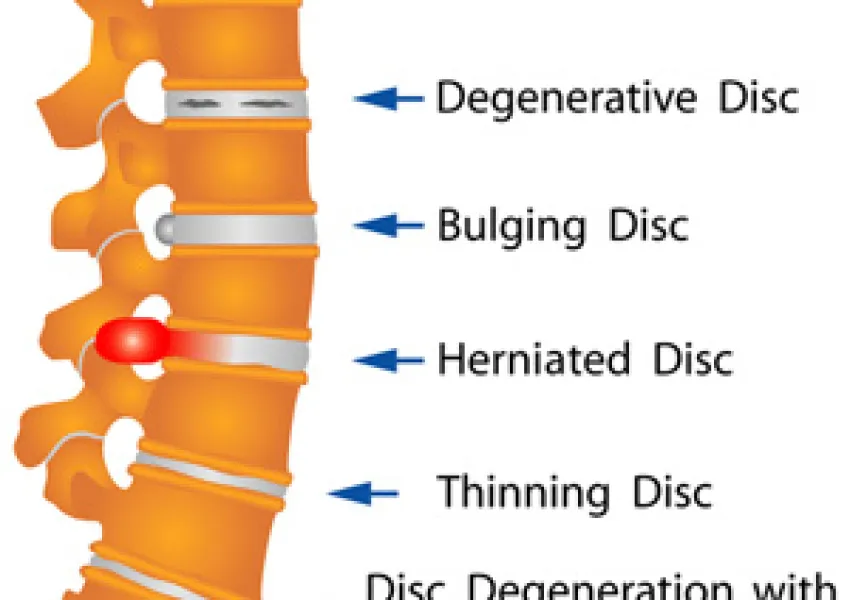 The Most Common Causes Of Lumbar Spine Pain - OrthoNeuro