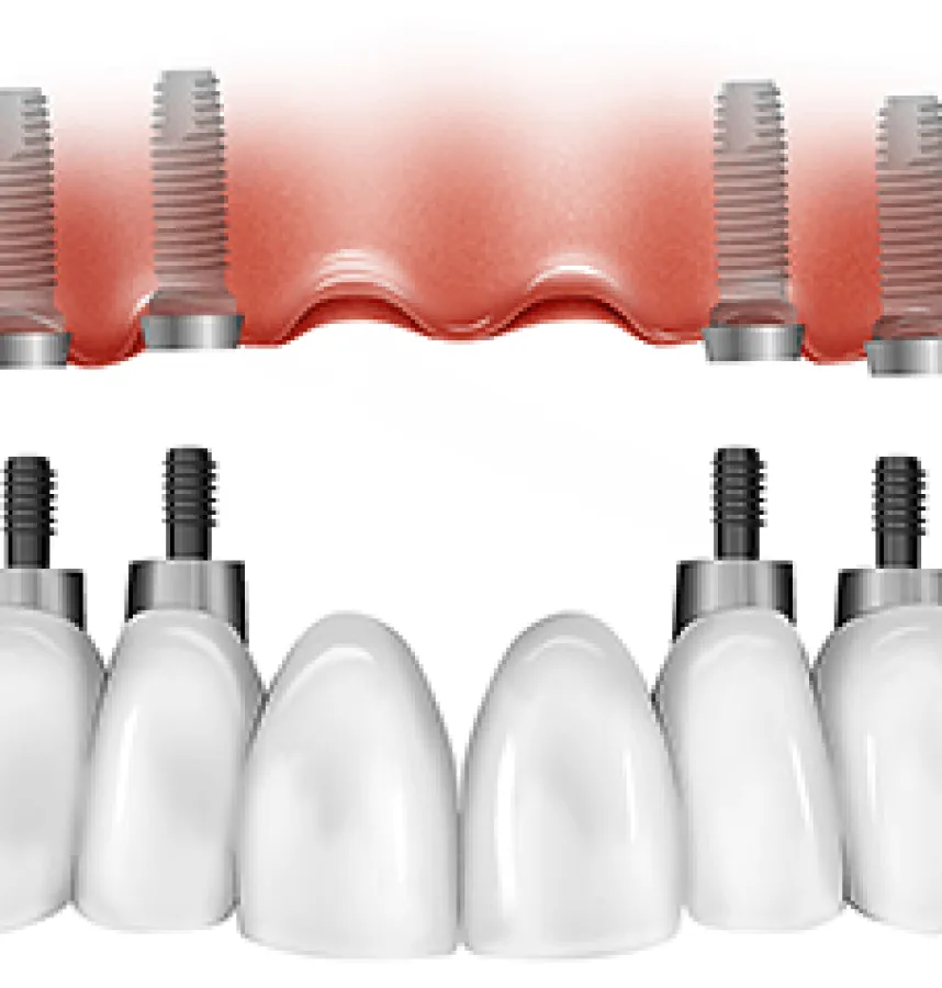 The Patient’s Guide To All-On-6 Dental Implants