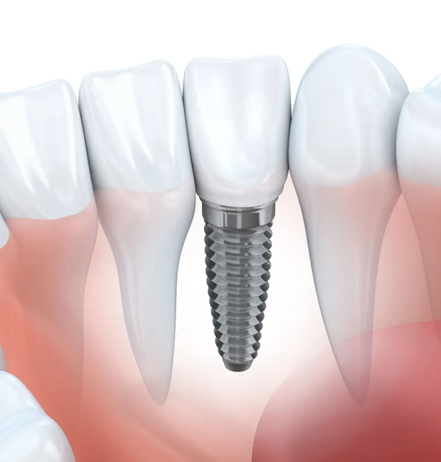 What Can Dental Implants do for You?