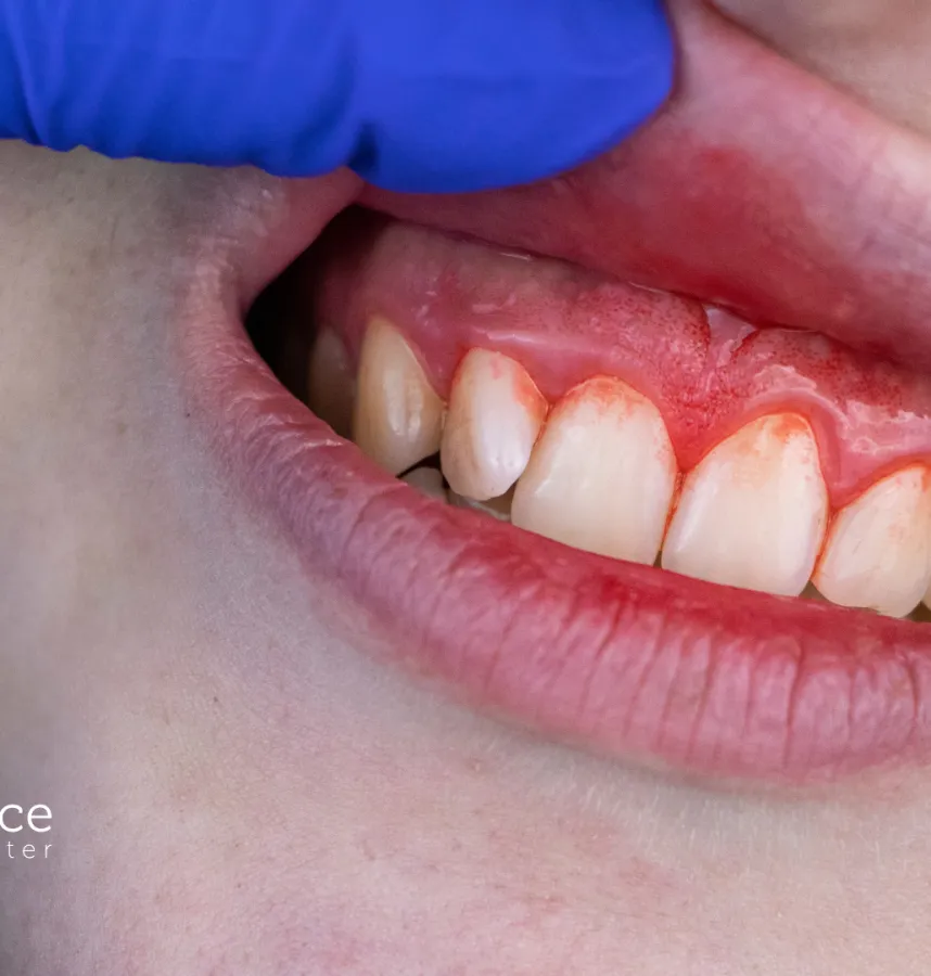 Why Do Gums Bleed? Common Causes and When to See a Dentist in Woodstock, GA