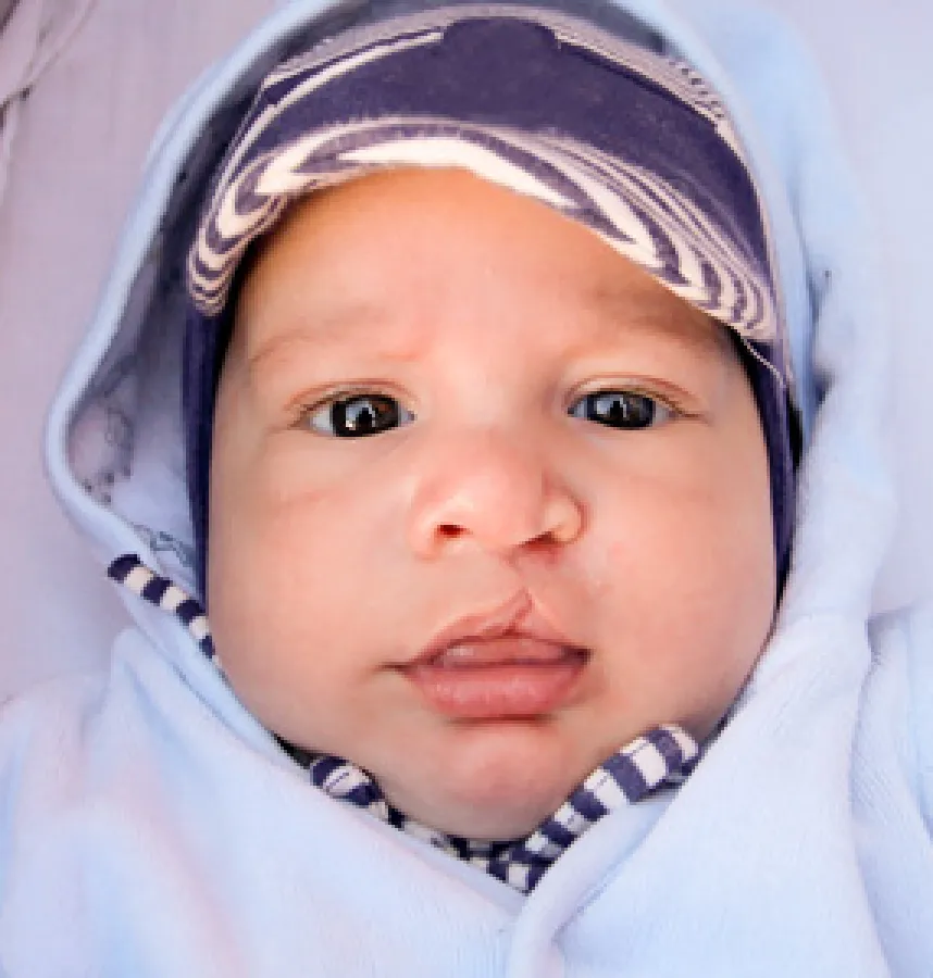 Cleft Repair can Restore a Smile, Change a Life