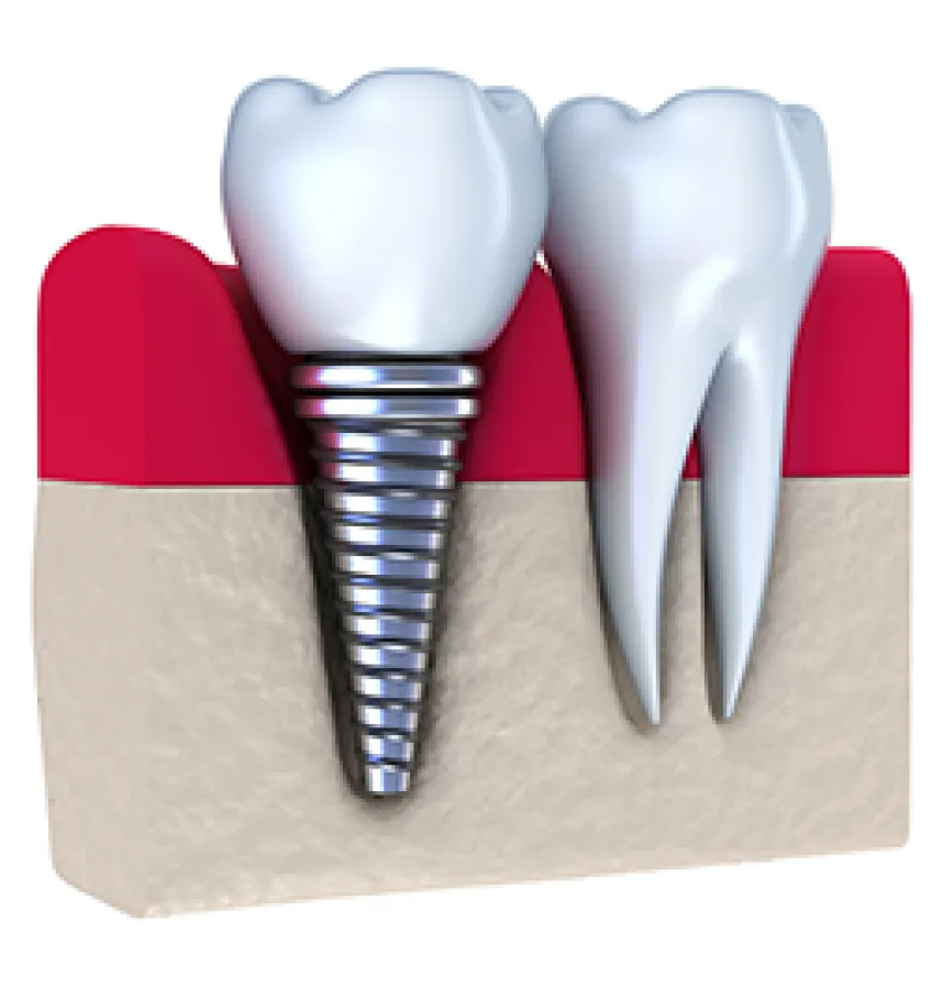 Dental Implants Oral Care