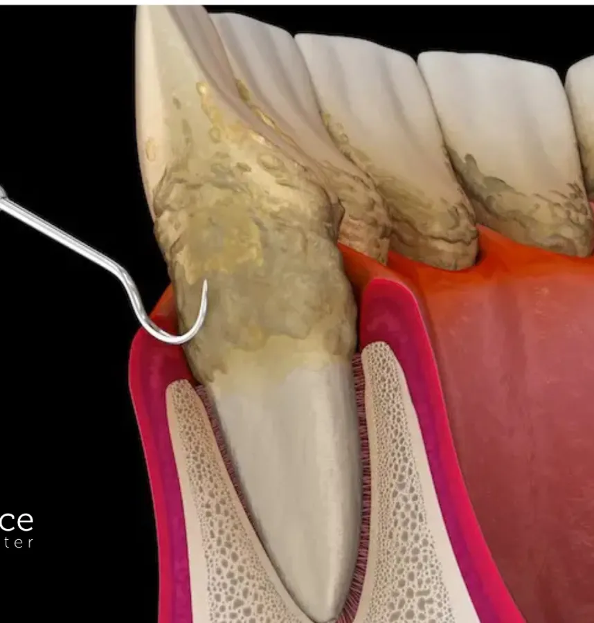 What Is a Deep Cleaning? Understanding Scaling and Root Planing