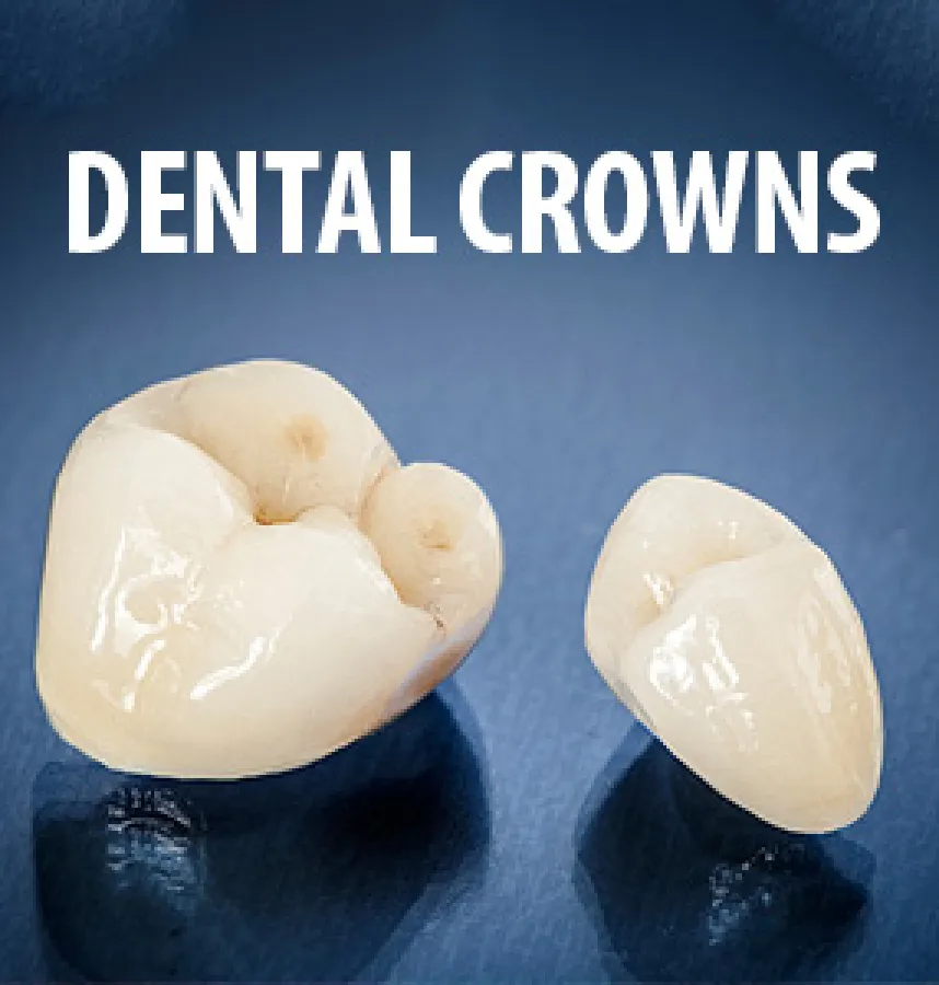 Are You in the Know About Dental Crowns? Take our True or False Quiz