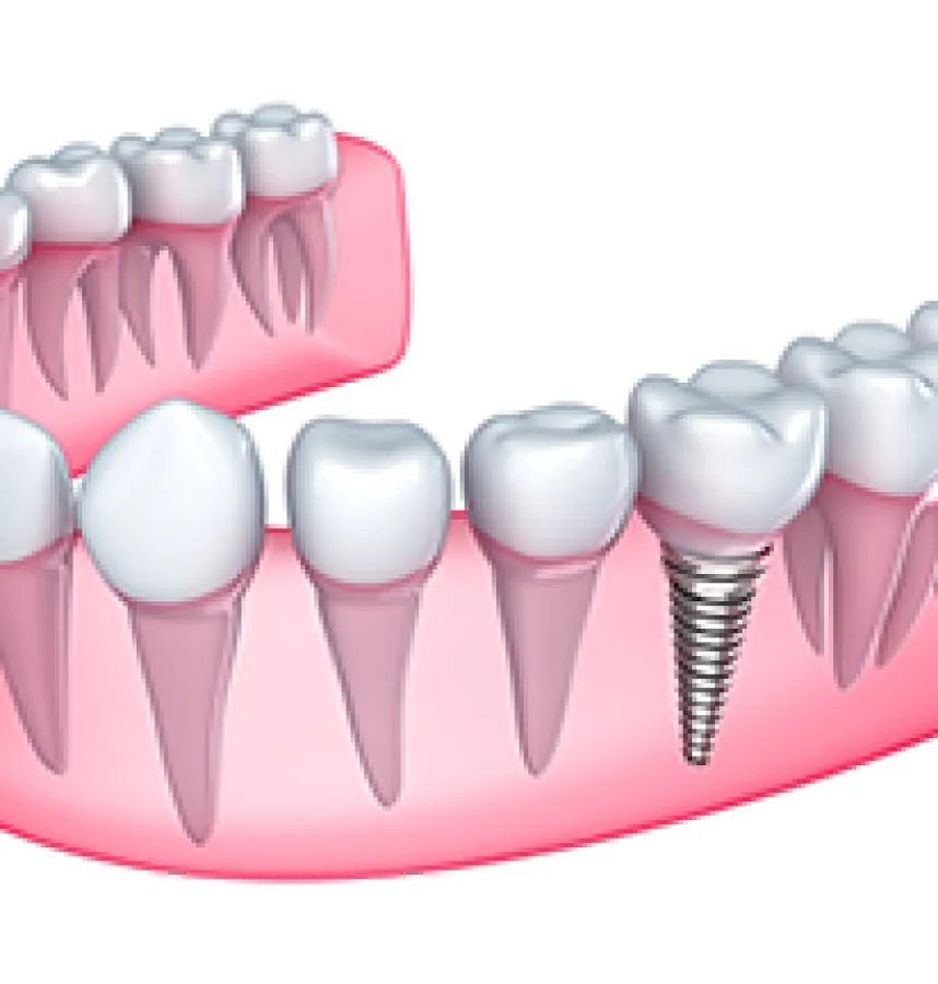 How Dental Implants Can Restore Your Missing Teeth
