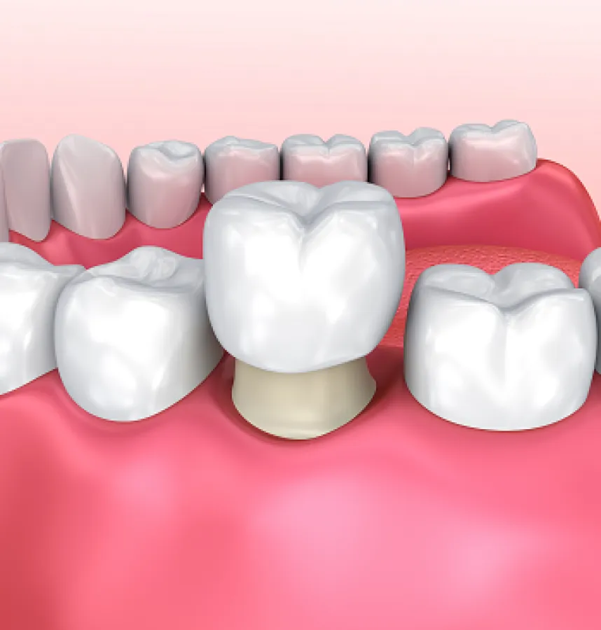 Discover the Benefits of CEREC Crowns