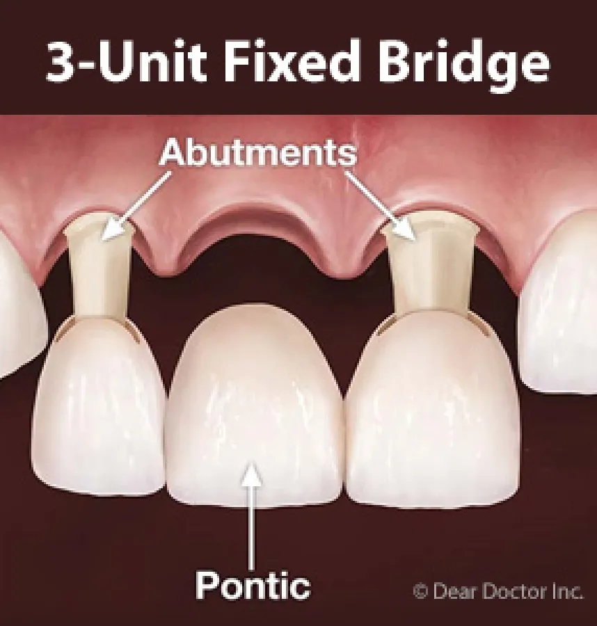 A Traditional Bridge Might be the Right Solution for Your Missing Teeth
