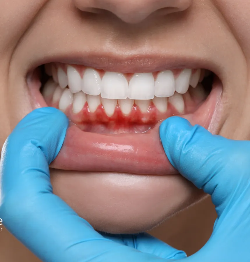 What Is Gingivitis? Early Gum Disease Signs