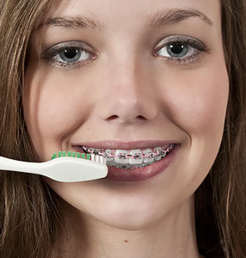 The Risk for Gum Disease Increases While Wearing Braces
