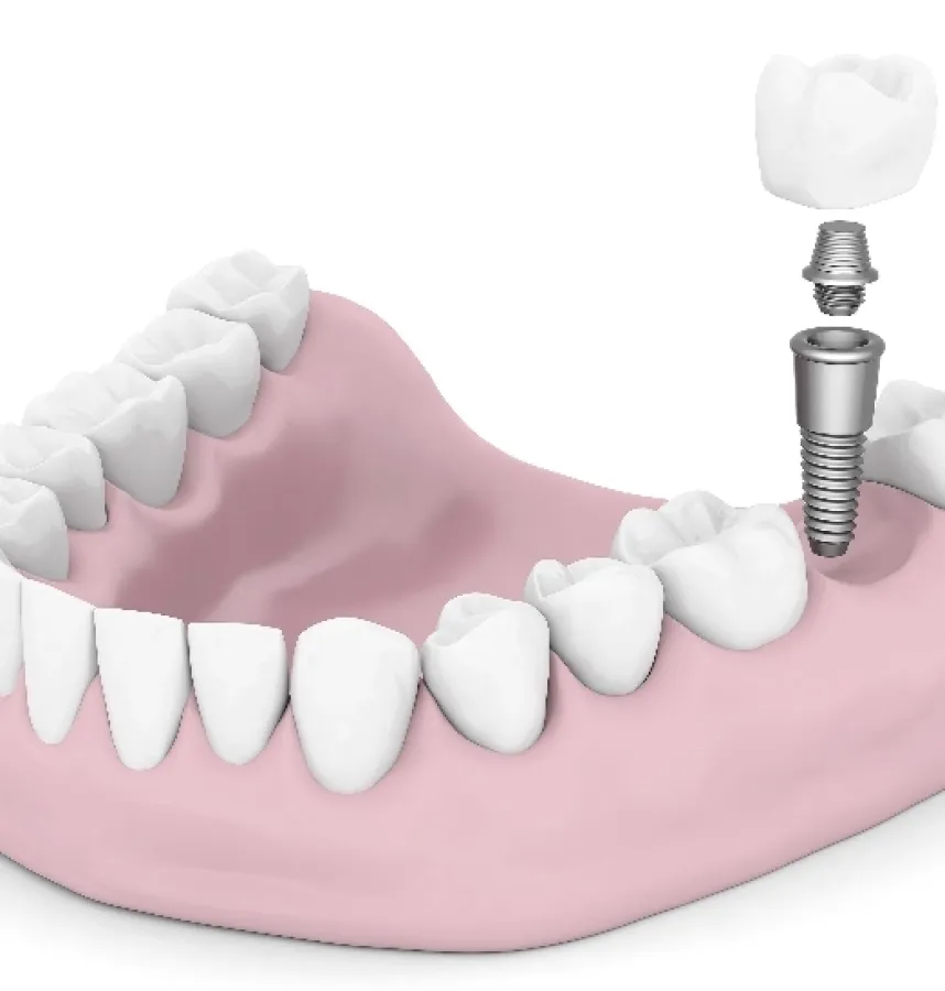 Can You Replace More Than One Missing Tooth With Dental Implants?