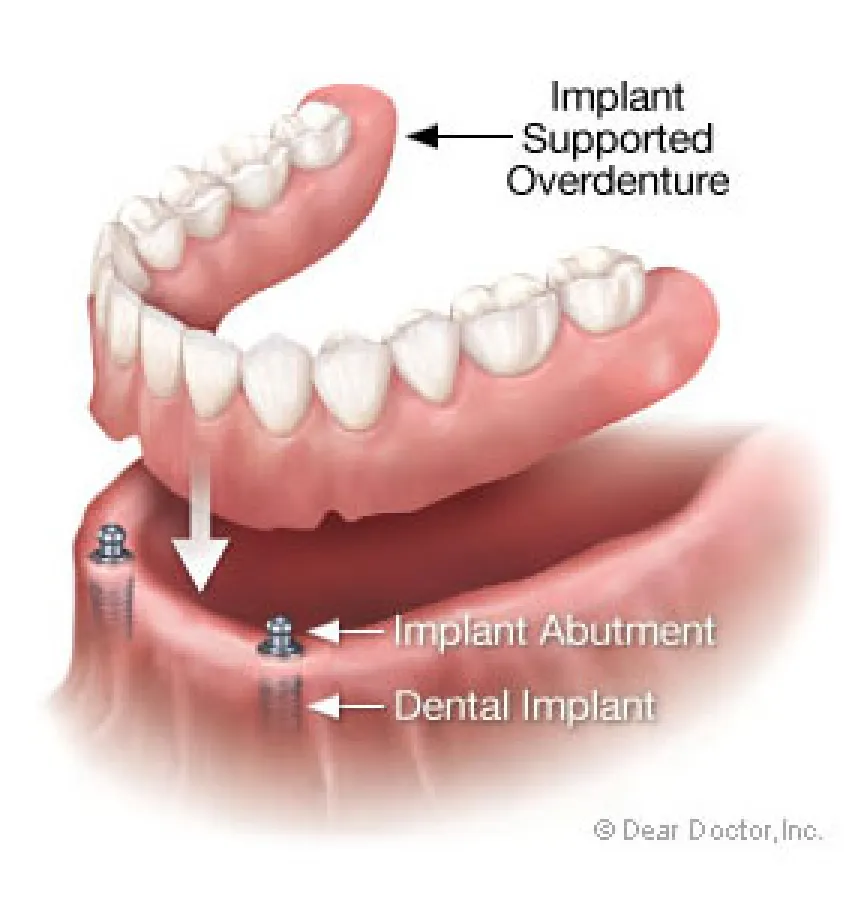 Implant-Supported Dentures Could Improve Your Bone Health