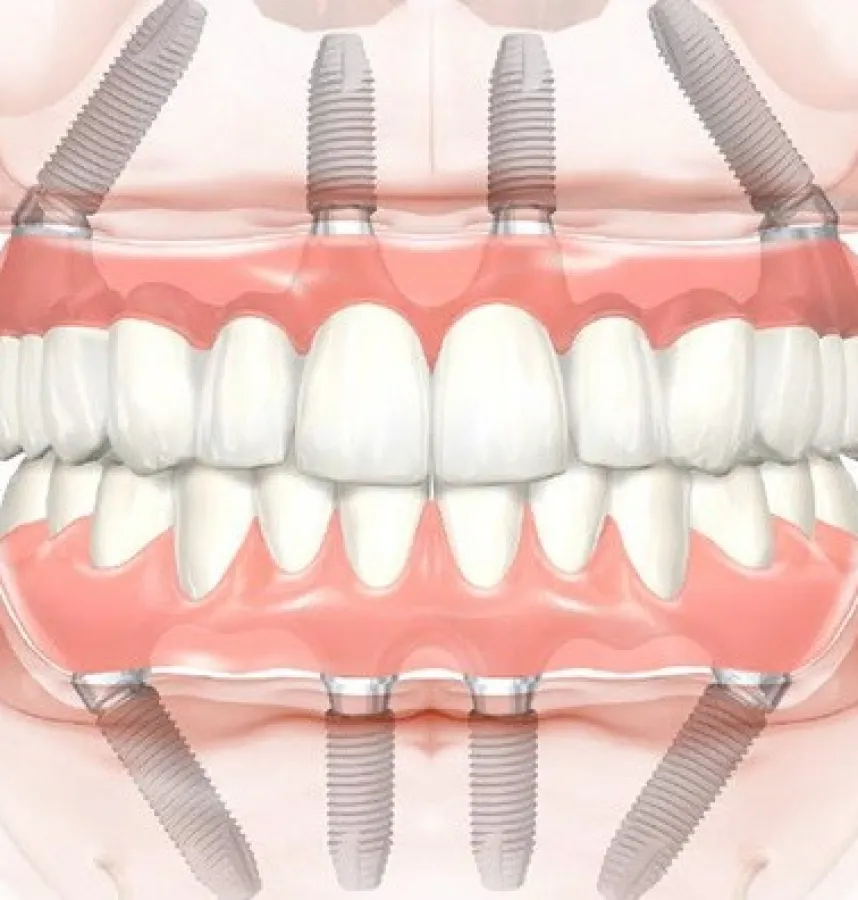 Are All-on-4/All-on-6 Dental Implants Permanent?