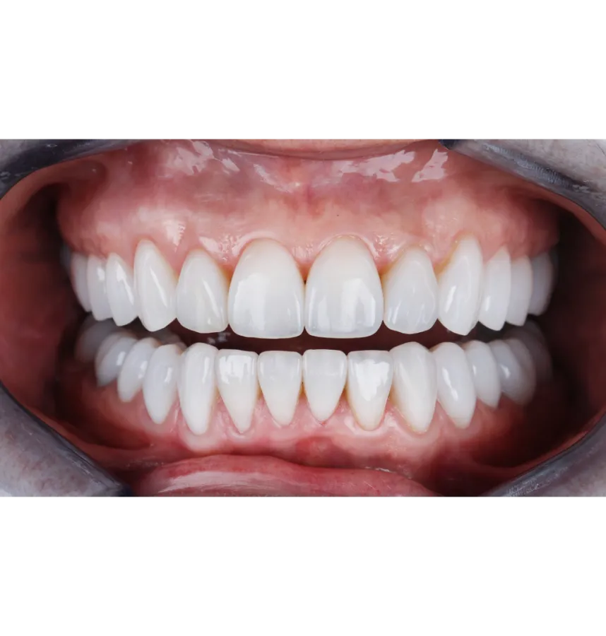 a person's mouth with teeth