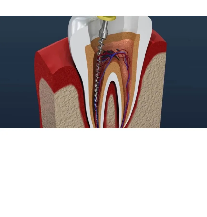 root canal therapy