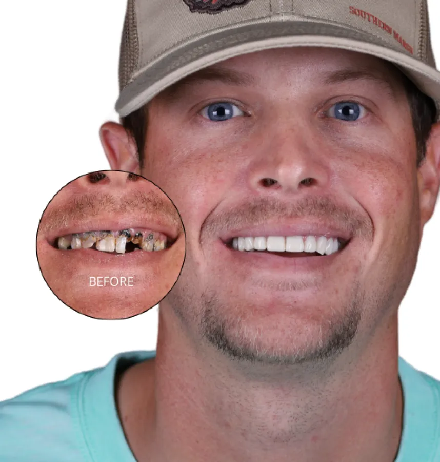 What Are Full Mouth Dental Implants?