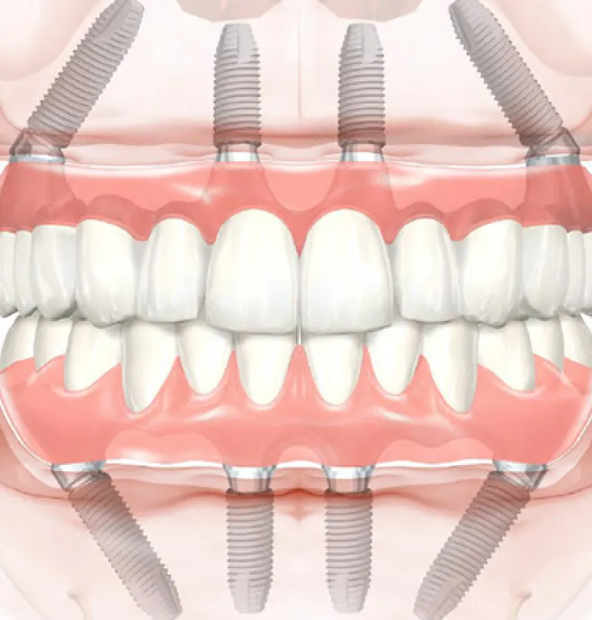 Are All-on-4 Dental Implants Removable?