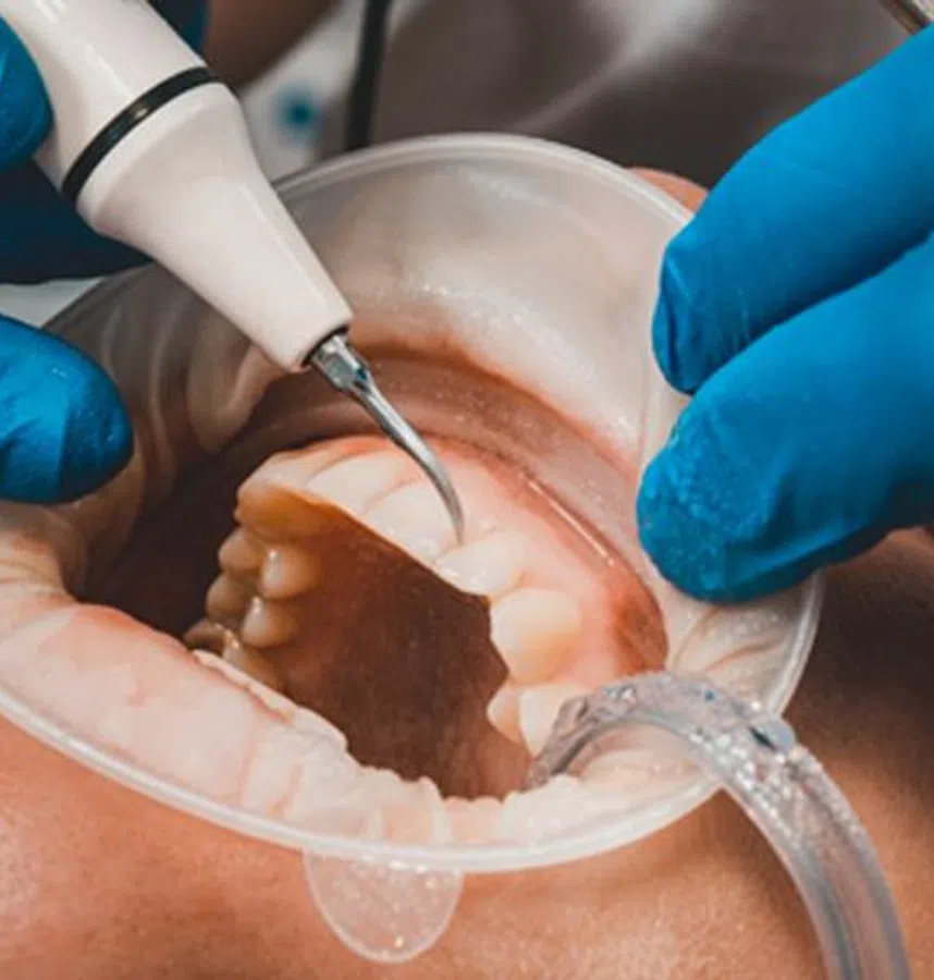 What Is Periodontal Disease? Symptoms, Bone Loss, and Treatment