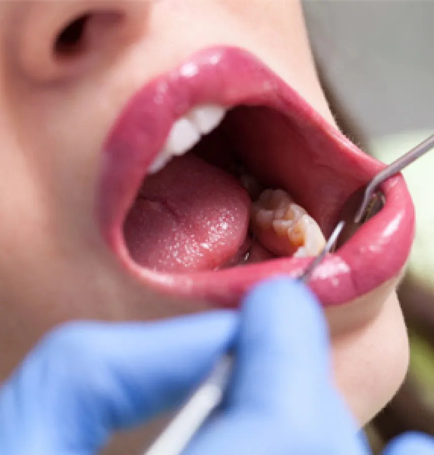 Regular Screenings Could Help With Early Oral Cancer Detection