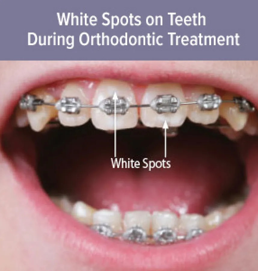 How to Reduce Tooth White Spots While Wearing Braces