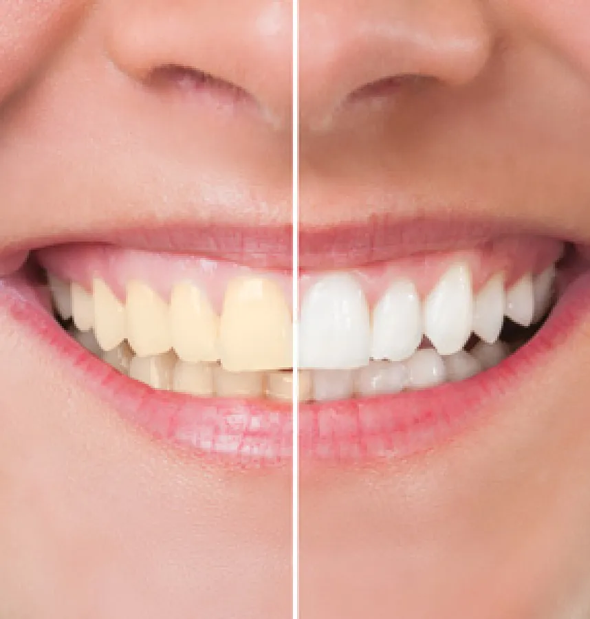 Answering Your Questions about Your Upcoming Teeth Whitening